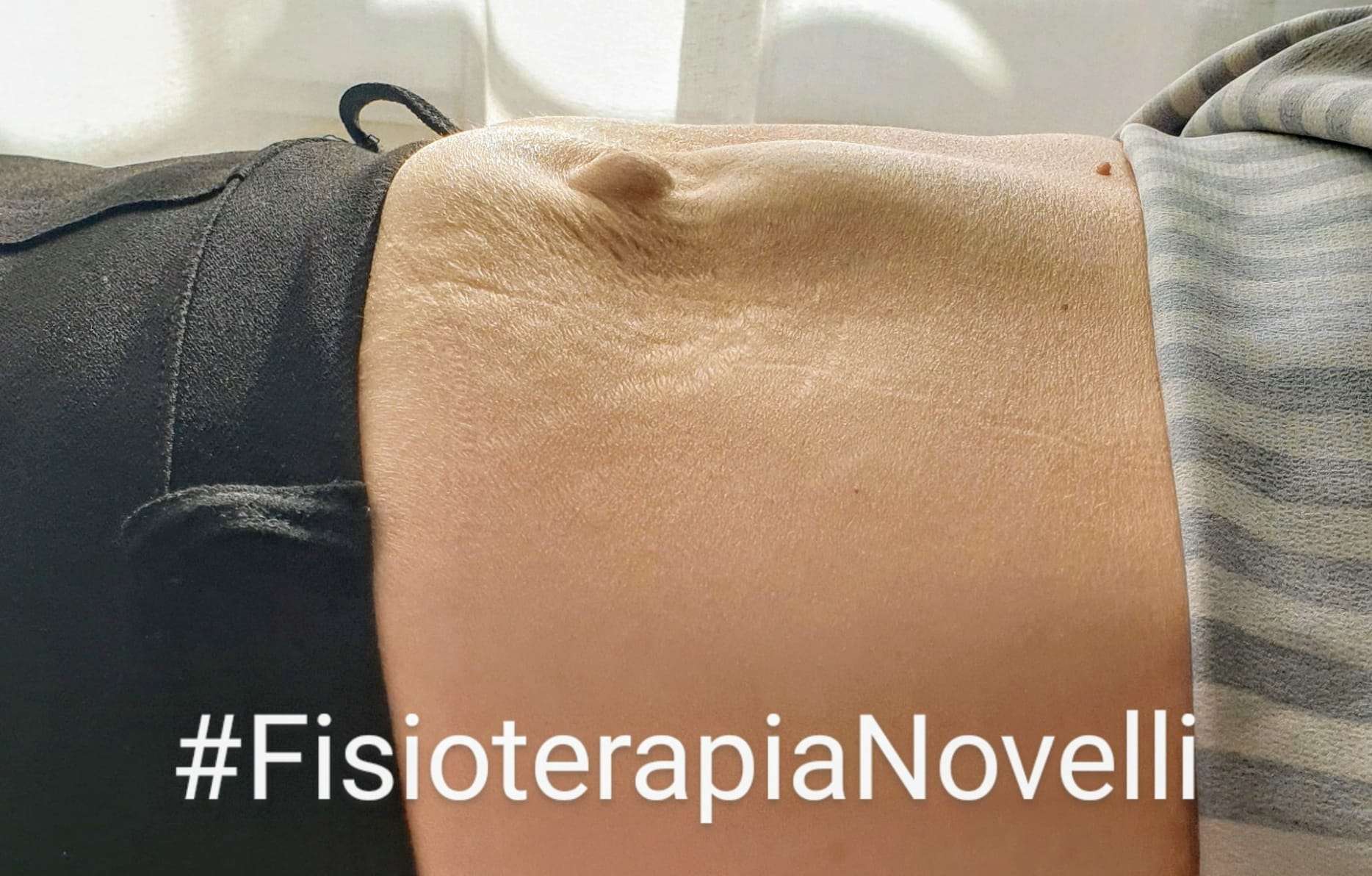 diastasi post partum | fisioterapia novelli